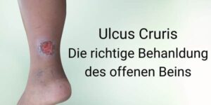 Die Behandlung Des Offenen Beins (Ulcus Cruris Venosum)